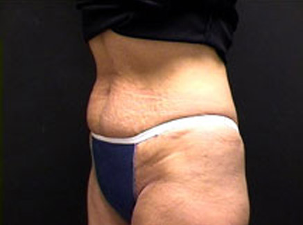Photo of Patient 04 Before Tummy Tuck