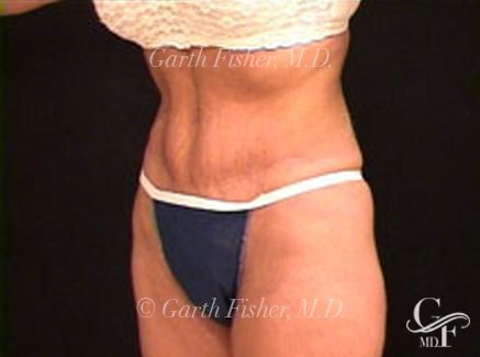 Photo of Patient 04 After Tummy Tuck