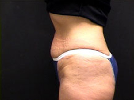 Photo of Patient 04 Before Tummy Tuck