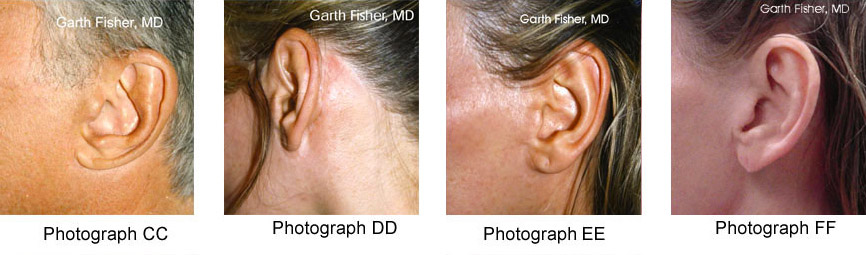 Dr. Garth Fisher's Facelift Scar Results