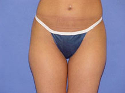 Photo of Patient 02 Before Body Contouring