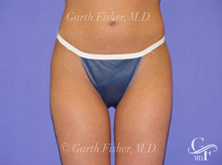 Photo of Patient 02 After Body Contouring