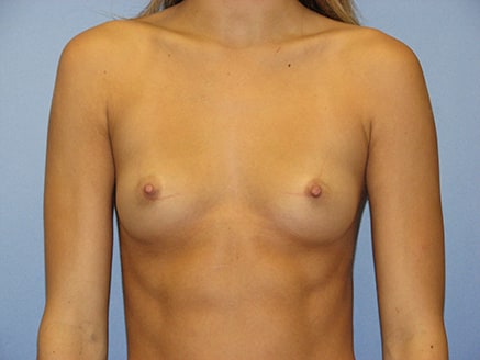 Photo of Patient 01 Before Breast Augmentation