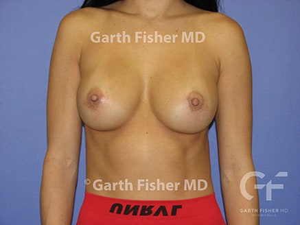 Photo of Patient 01 After Breast Augmentation