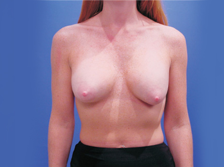 Photo of Patient 01 Before Breast Lift