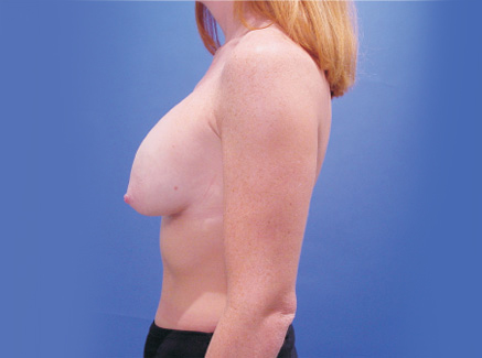Photo of Patient 01 Before Breast Lift