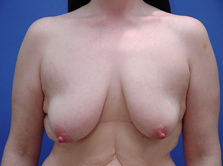 Photo of Patient 05 Before Breast Lift