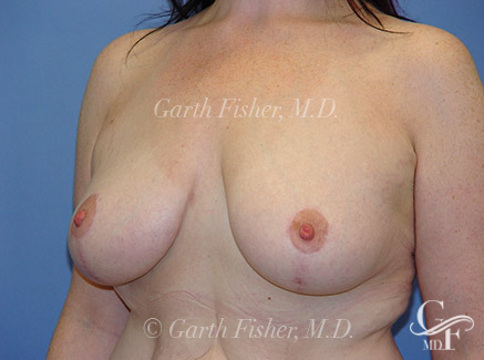 Photo of Patient 05 After Breast Lift