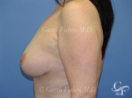 Photo of Patient 05 After Breast Lift