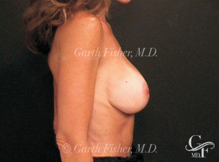 Photo of Patient 01 After Breast Revision