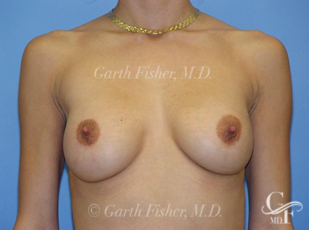 Photo of Patient 02 After Breast Revision