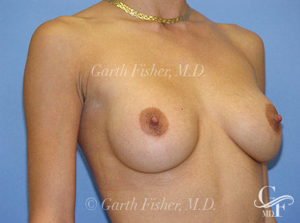 Photo of Patient 02 After Breast Revision