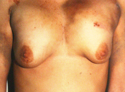 Photo of Patient 05 Before Breast Revision