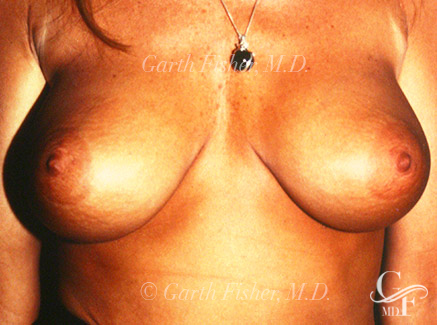 Photo of Patient 05 After Breast Revision