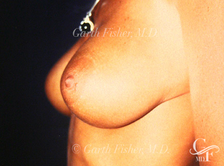 Photo of Patient 05 After Breast Revision