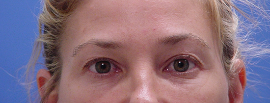 Photo of Patient 04 Before Blepharoplasty