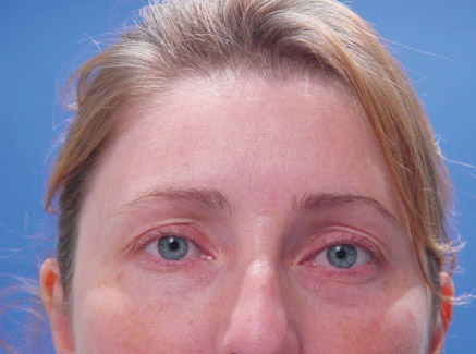 Photo of Patient 03 Before Brow Lift
