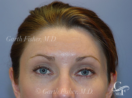 Photo of Patient 03 After Brow Lift