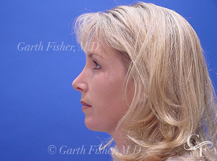 Photo of Patient 02 After Chin Augmentation
