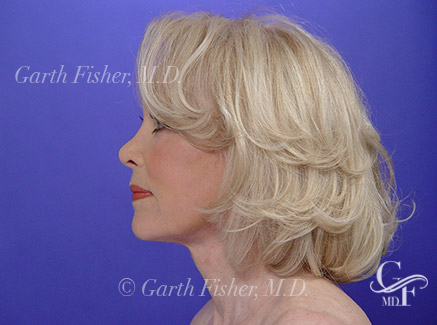 Another Patient's amazing Facelift results looking forward
