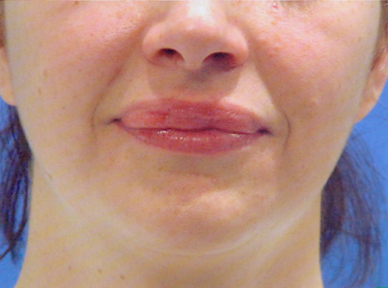 Photo of Patient 02 Before Lip Augmentation
