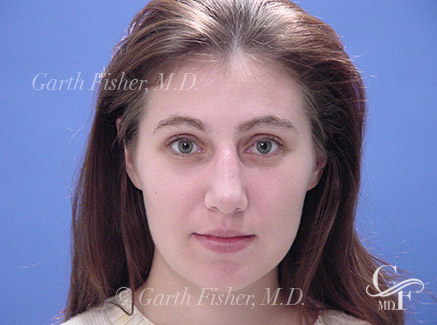 Photo of Patient 12 After Primary Rhinoplasty
