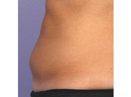Photo of Patient 01 After Coolsculpting