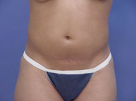 Photo of Patient 04 Before Body Contouring