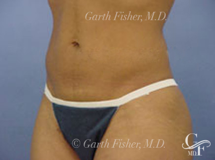 Photo of Patient 04 After Body Contouring