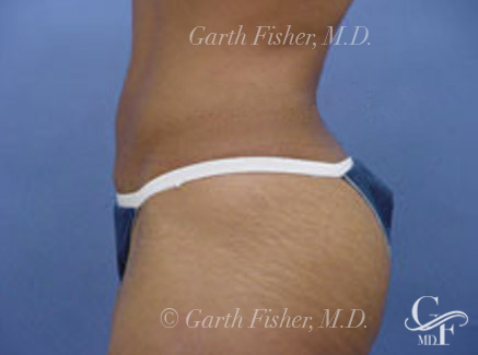 Photo of Patient 04 After Body Contouring