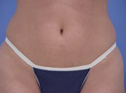 Photo of Patient 06 Before Body Contouring