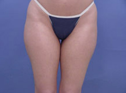 Photo of Patient 06 Before Body Contouring