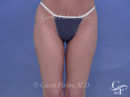 Photo of Patient 06 After Body Contouring