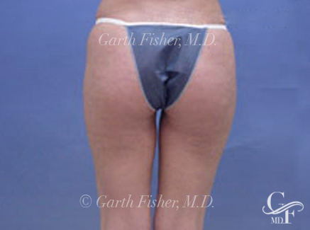 Photo of Patient 06 After Body Contouring
