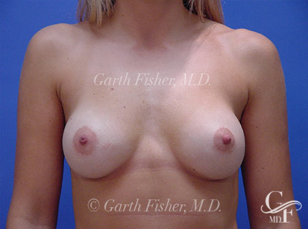 Photo of Patient 09 After Breast Augmentation
