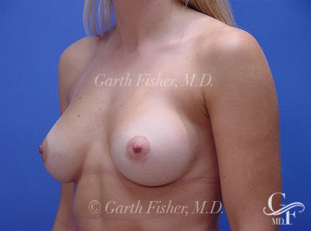 Photo of Patient 09 After Breast Augmentation