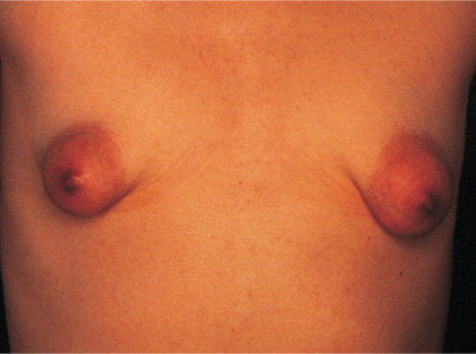Photo of Patient 02 Before Breast Lift