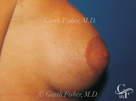 Photo of Patient 02 After Breast Lift