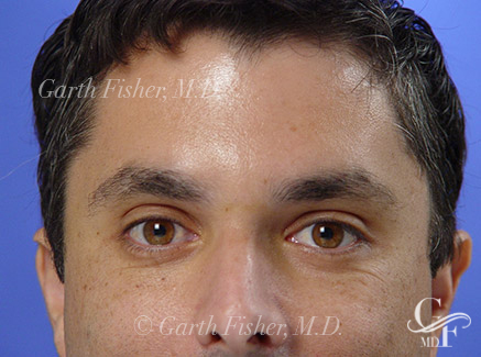 Photo of Patient 04 After Brow Lift