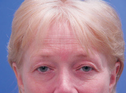 Photo of Patient 05 Before Brow Lift