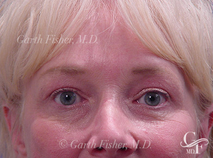 Photo of Patient 05 After Brow Lift
