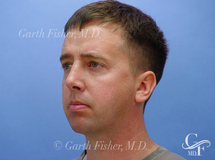 Photo of Patient 05 After Chin Augmentation