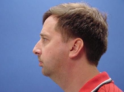 Photo of Patient 05 Before Chin Augmentation