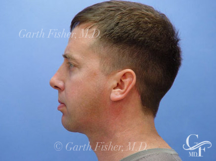 Photo of Patient 05 After Chin Augmentation