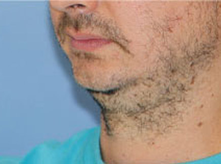 Photo of Patient 06 Before Chin Augmentation