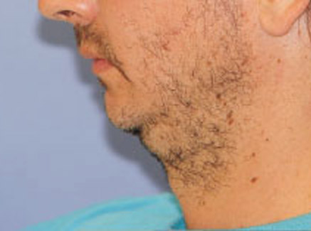 Photo of Patient 06 Before Chin Augmentation