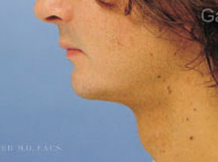 Photo of Patient 06 After Chin Augmentation