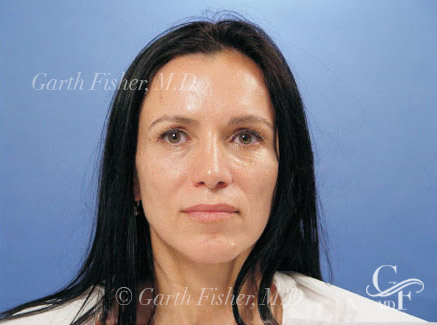 Photo of Patient 09 After Primary Rhinoplasty