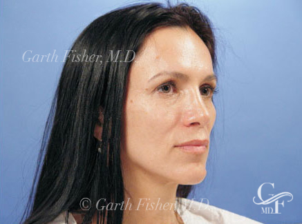 Photo of Patient 09 After Primary Rhinoplasty