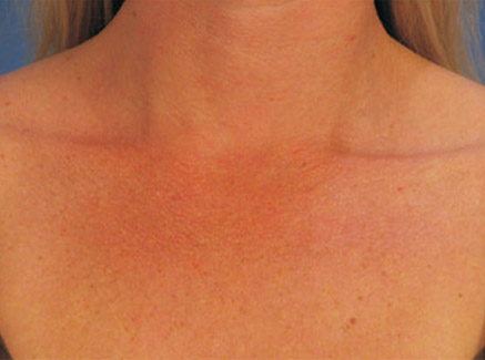 Photo of Patient 05 Before Skin/Laser Treatments